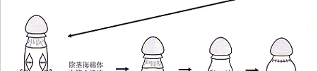 屈曲ペニス修正手術法
