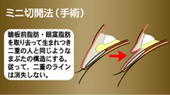 埋没法