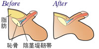 長茎手術イラスト